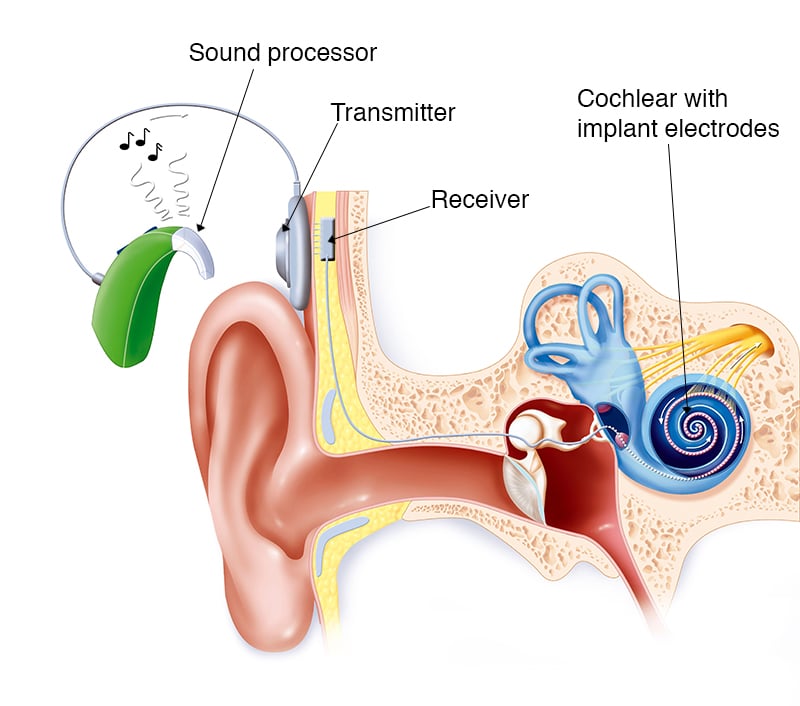 Cochlear Implant Part 1 What are Cochlear Implants and How Do They